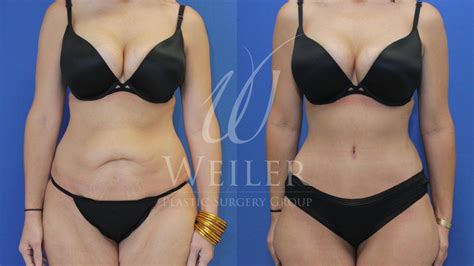 Before and after tummy tuck and breast implants - cfvar