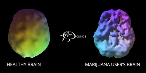 Marijuana Drops Blood Flow in the Brain | Amen Clinics