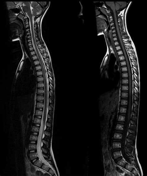 Normal Cervical Spine