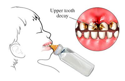 baby bottle tooth decay symptoms