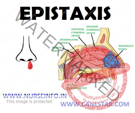 EPISTAXIS - Nurse Info