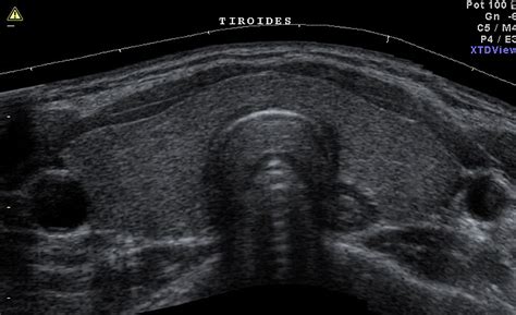 Ecografia tiroidea - Centro Médico Semecor