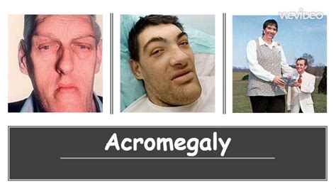 History Of Acromegaly Acromegaly Diagnosis Treatment - vrogue.co