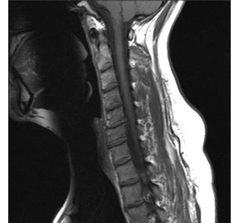 File:Cervical Spine MRI showing disc herniation.jpg - Wikimedia Commons