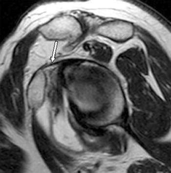 MRI Musculo-Skeletal Section: -How to locate coracohumeral ligament.