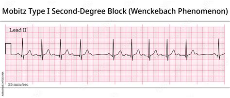 Wenckebach Phenomenon - ECG Mobitz Type 1 Second Degree ...