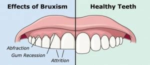 Tooth pain - Southlake Endodontics