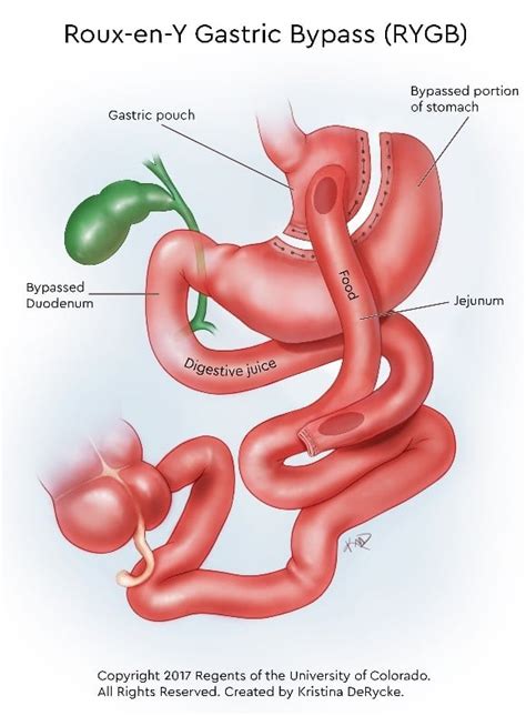 Bariatric Surgery Types | Children's Hospital Colorado