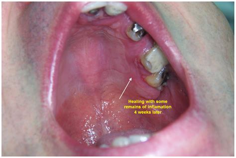 Acute Herpetic Gingivostomatitis