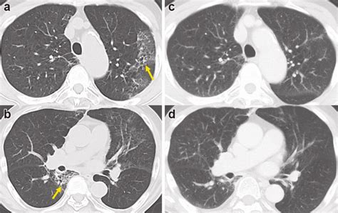 Chest CT images. (a, b) CT performed 2 days after COVID-19 infection ...