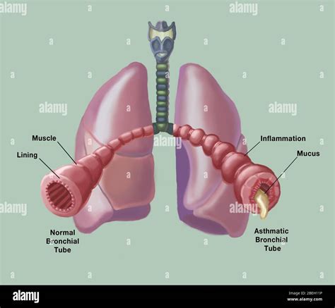 53+ Diagram Of Bronchial Tubes - KaylumColby