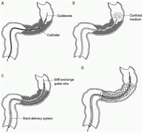 Colorectal Stent Placement | Radiology Key