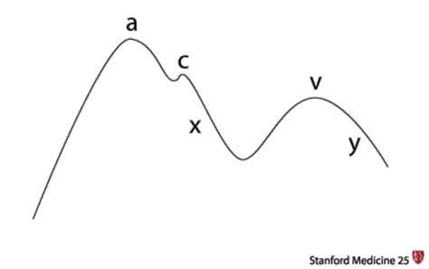 Jugular Venous Pressure Waveform