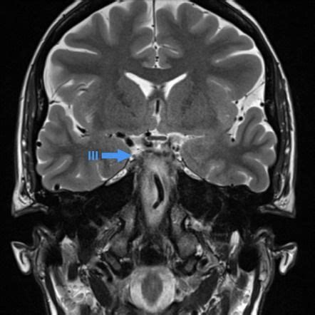 Oculomotor nerve (normal) | Radiology Case | Radiopaedia.org | Radiology, Pharmacology nursing ...