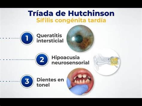 🔴 TRIADA DE HUTCHINSON - YouTube