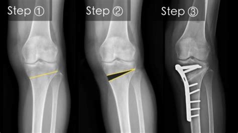 High Tibial Osteotomy - BSM Foundation