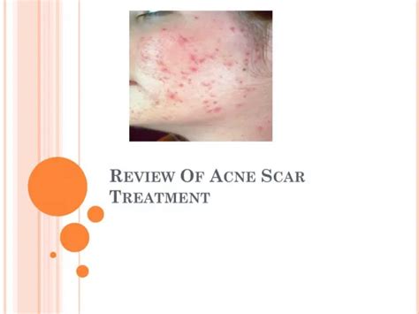 PPT - Acne Scar Treatment PowerPoint Presentation, free download - ID:12400718