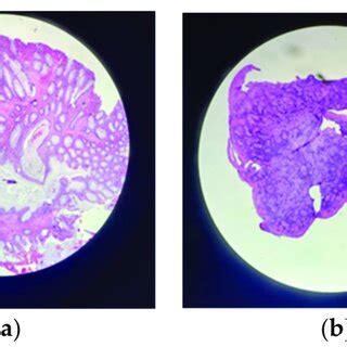 Lower digestive endoscopy: (a) terminal ileum; (b) ileocecal valve; (c ...