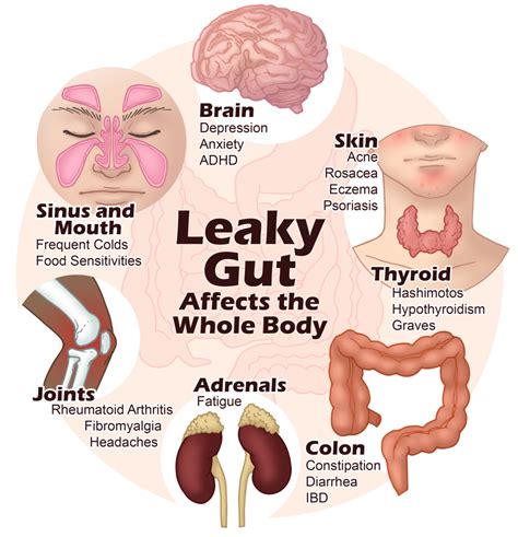 5 Step Formula to Heal Leaky Gut Naturally - Paula Owens