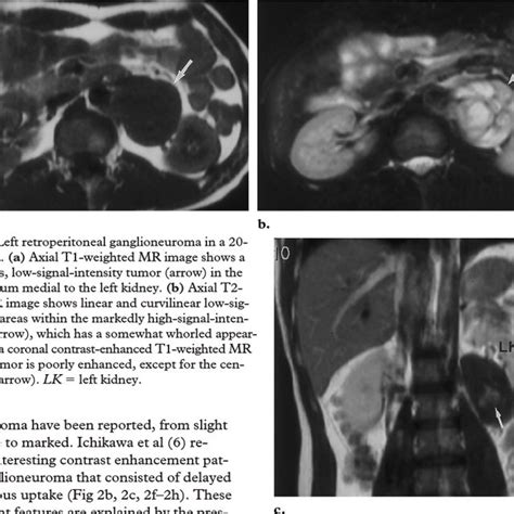 (PDF) Neurogenic Tumors in the Abdomen: Tumor Types and Imaging ...