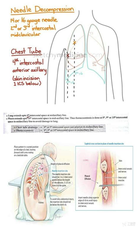 Chest tube drainage & Thoracocentesis... ( Muscle pierced during Pleural tapping : 3 ...