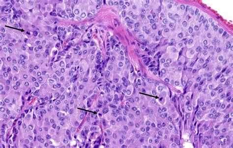 Pathology Outlines - Atypical carcinoid tumor / neuroendocrine tumor, grade 2