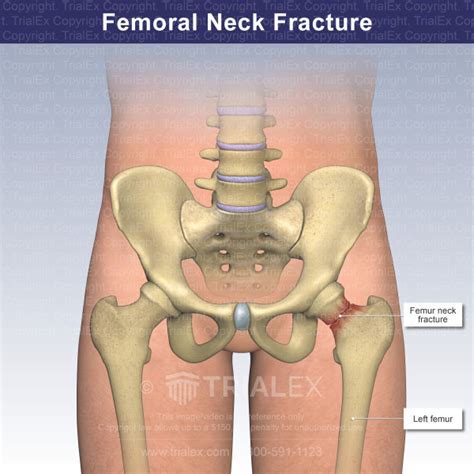 Femoral Neck Fracture - Trial Exhibits Inc.