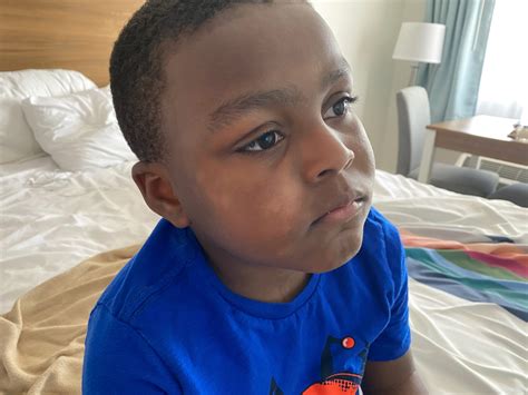 What Are The Lighter Or White Spots On My Black Child’s Face?