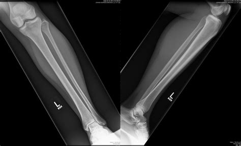 AP and lateral tibia-fibula radiographs | NucsRadiology.com