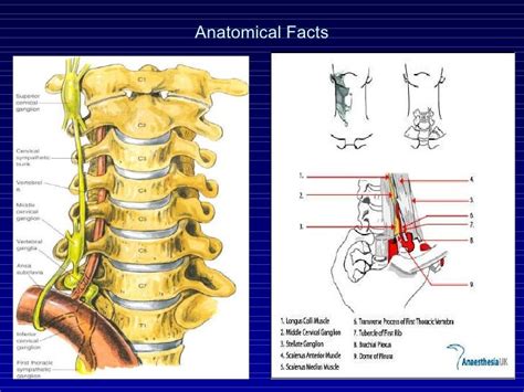 Modified stellate ganglion block