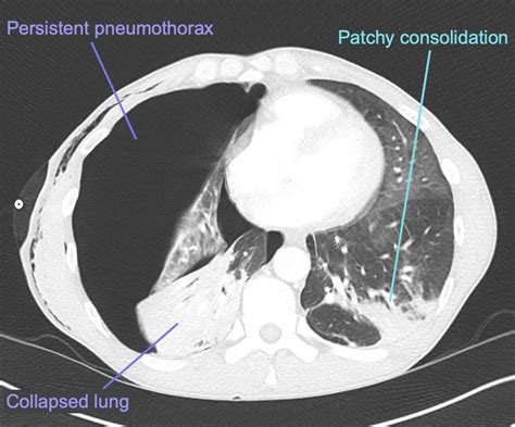 CT Case 029 • LITFL • CT scan interpretation