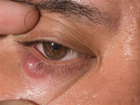 Top Causes Of Swollen Eyelids That You Need To Know About - Boldsky.com