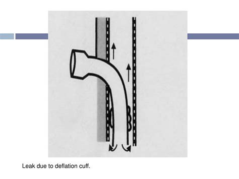 PPT - TRACHEOSTOMY CARE PowerPoint Presentation, free download - ID:5949140