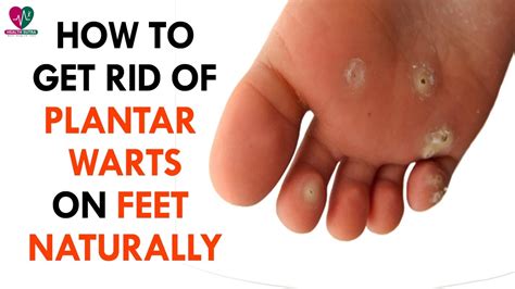 Pictures Of Plantar Warts On Feet