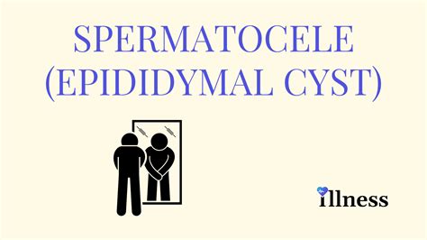 Spermatocele (Epididymal Cyst) : Overview, Causes, Symptoms, Treatment - illness.com