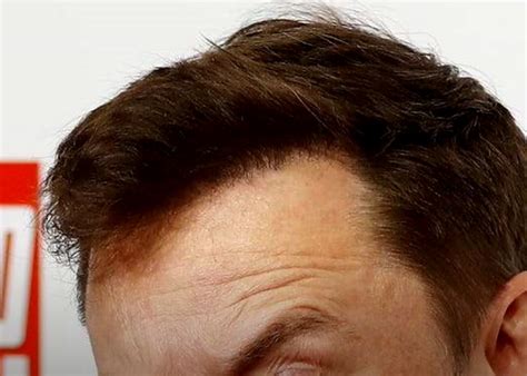 Elon Musk Hair Transplant History and Hair Analysis before and after