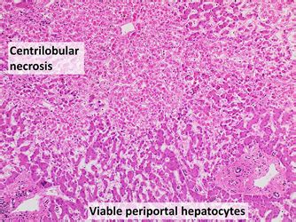 Liver Necrosis | Overview & Types | Study.com