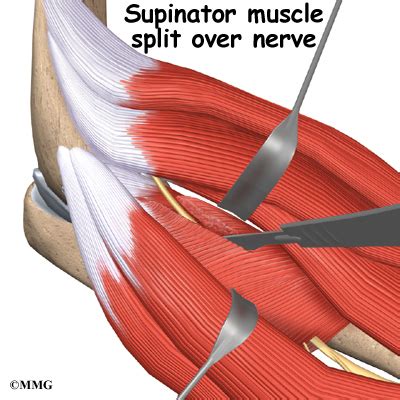 Radial Tunnel Syndrome - eOrthopod.com