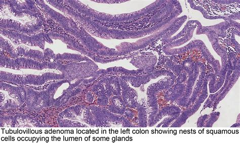 Pathology Outlines - Tubulovillous / villous adenoma