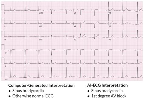 Cardiac Tamponade Ecg Strip