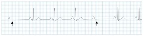 AV Block: 2nd degree, Mobitz II (Hay block) • LITFL • ECG Library