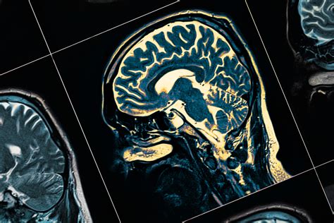 Large-scale analysis links glucose metabolism proteins in the brain to Alzheimer’s disease ...