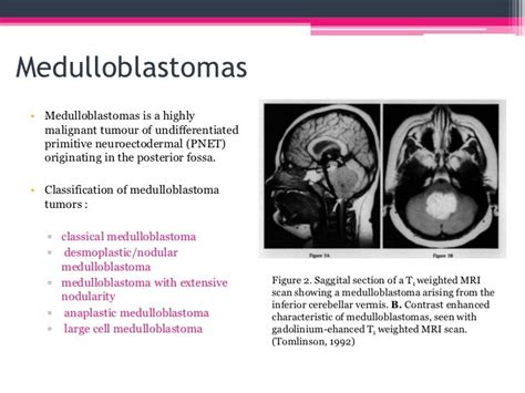 Pediatric medulloblastoma