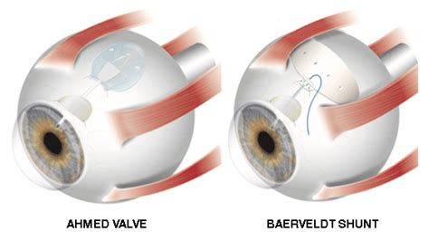 Glaucoma Tube Shunts | Wills Eye Hospital