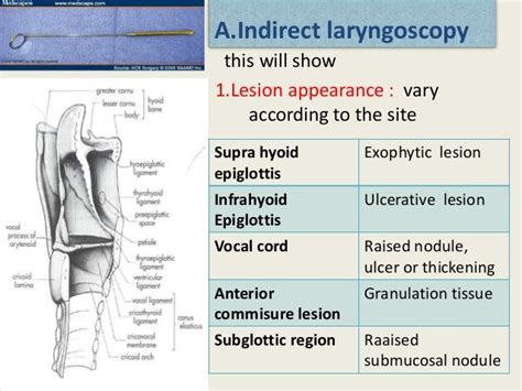 Diagnosis and treatment of carcinoma of larynx by nitesh Kr.