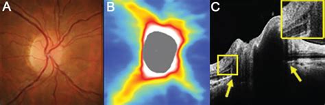 GC-IPL Shown on OCT-A May Show Early Papilledema Damage