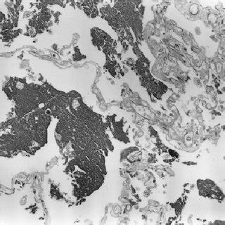 Microscopic features of the lung tissue (PAS stain). Alveoli are filled... | Download Scientific ...