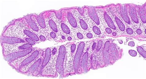 Pathology Outlines - Lymphocytic colitis