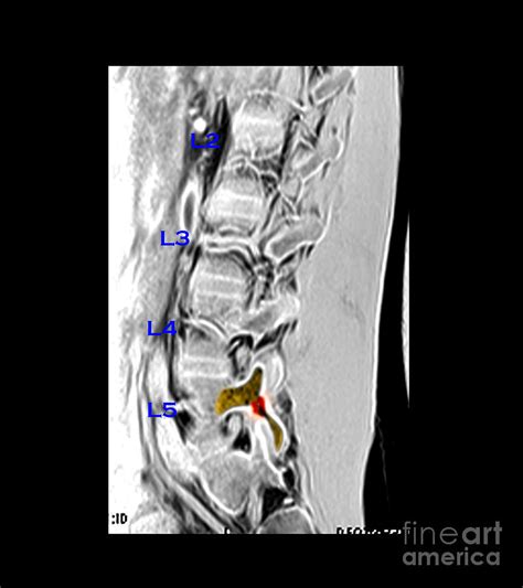 Mri Of L5 Spondylolysis Photograph by Living Art Enterprises