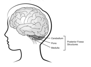 Posterior Cranial Fossa Tumor